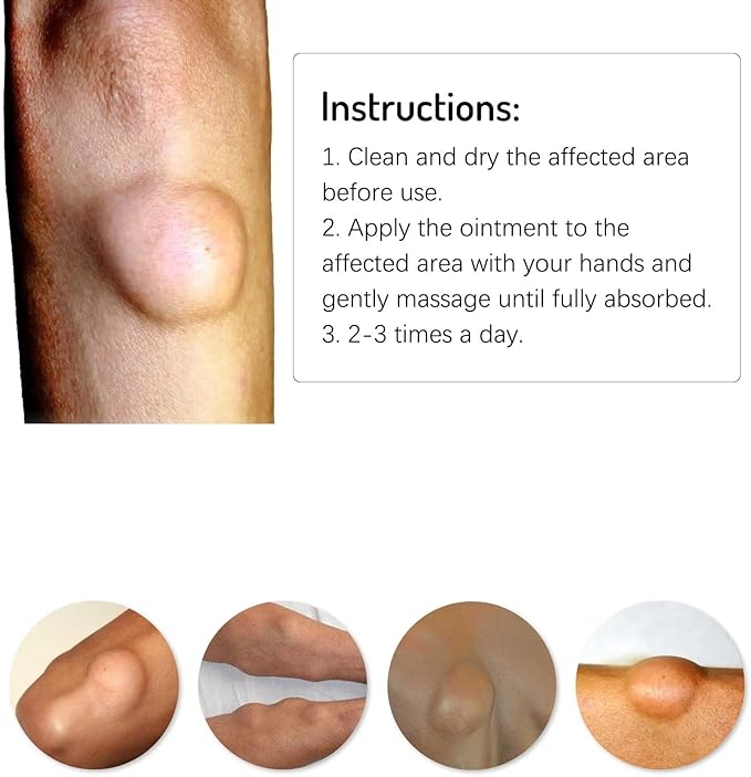 Lipoma Cream