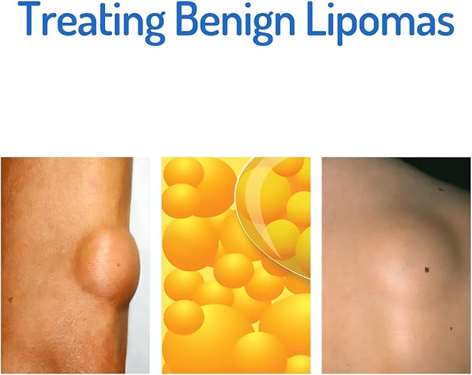 Lipoma Cream