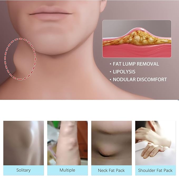 Lipoma Cream