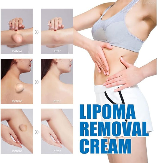 Lipoma Cream